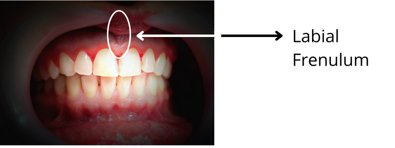 Lingual Frenulum Bump