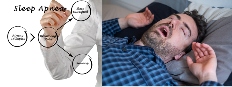 Sleep Apnea Myofunctional Therapist